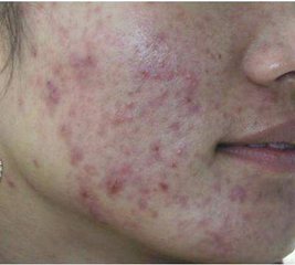 沈阳肤康皮肤病医院--引起湿疹的常见原因一般有哪些