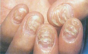 灰指甲患者怎么避免传染身边人 沈阳灰指甲医院